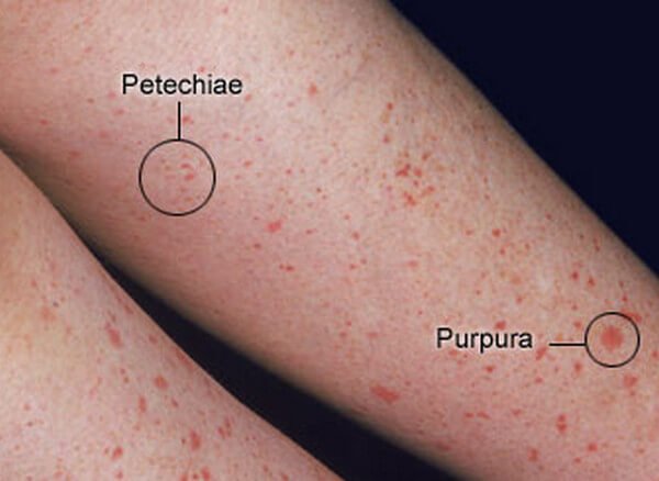 petechiae-from-scratching