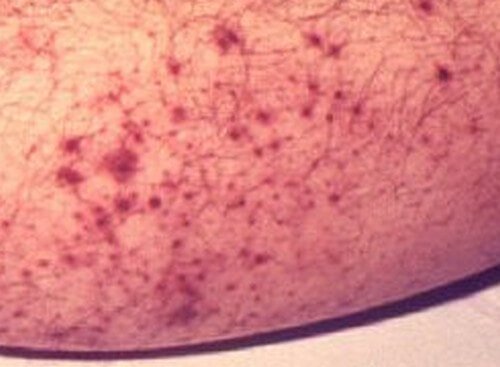 Red-purple spots on legs - RightDiagnosis.com