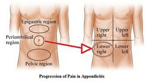 appendicitis pain location