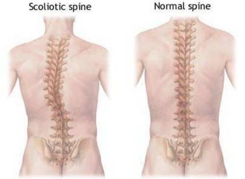 What Is Levoscoliosis Lumbar Vs Thoracic Causes Treatment