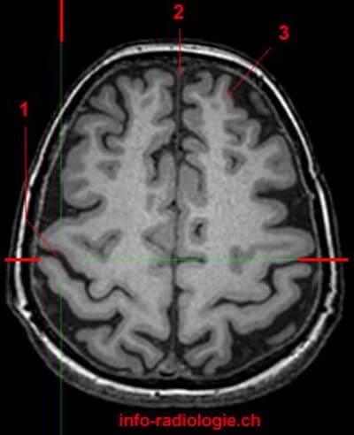MRI of the brain in T1-weighted sagittal view picture