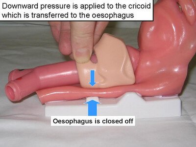 Sellick Maneuver or Cricoid Pressure picture