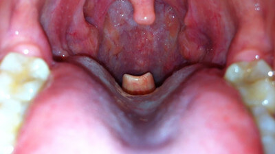 Epiglottis at the back of the tongue photo