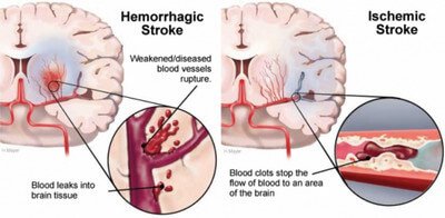 Hemorrhagic Stroke vs. Ischemis Stroke photo