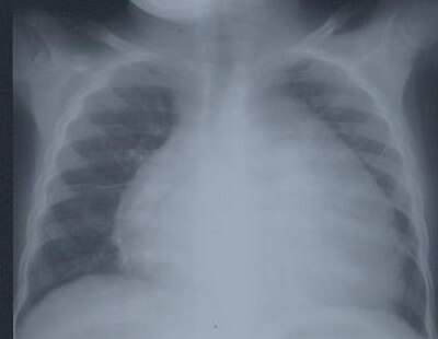 Radiograph showing cardiomegaly picture