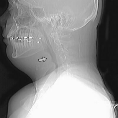 thumbprint sign swollen epiglottis xray image