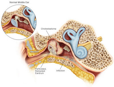 Cholesteatoma picture