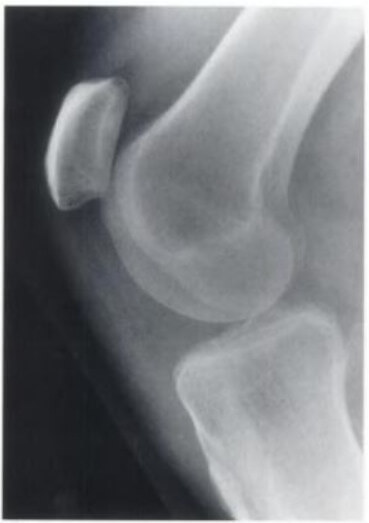 Patella Tendon Rupture X Ray