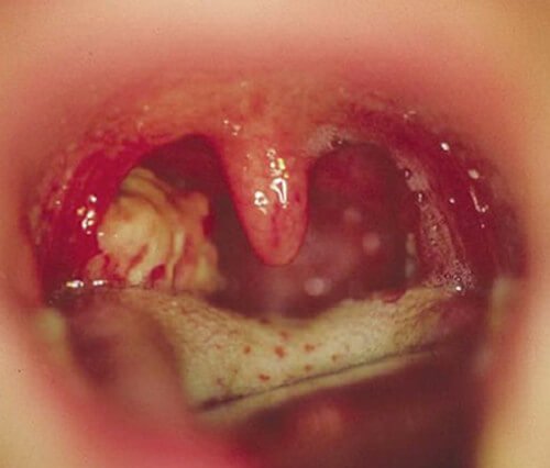 Lingual Tonsils - Tonsillitis and Pictures