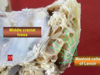 Mastoid Cells of Lenoir image