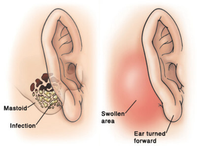 Mastoiditis is caused by bacterial infection causing the ear, particularly the posterior area, to appear swollen and picture