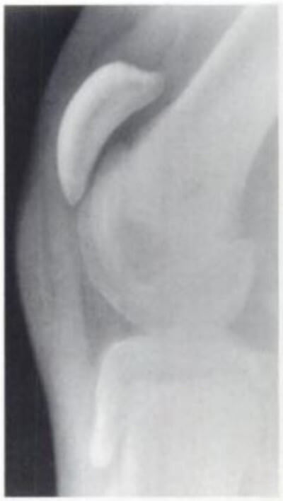 Patella alta in cerebral palsy features a lengthened and high positioned patella due to chronic spasms image