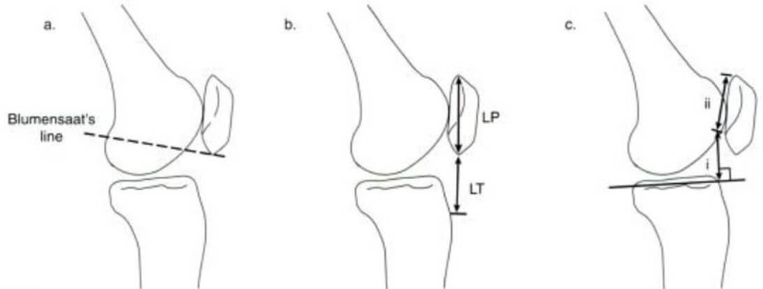 a) Blumensaat's Line; b) Insall-Salvati Measurement; c) Blackburn-Peel Measurement photo