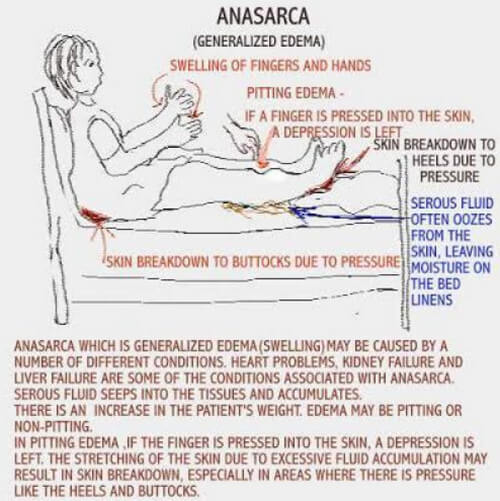 retention fluid Definition, Anasarca Causes Treatment  and