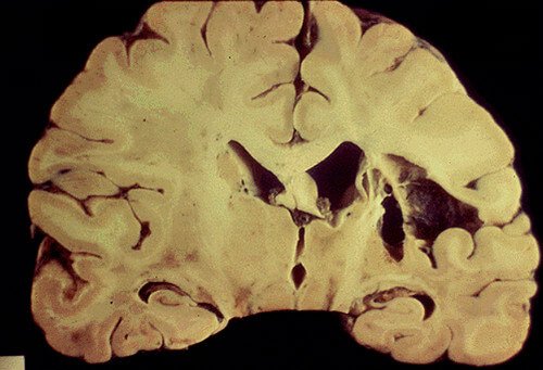 Gross cystic encephalomalacia caused by cerebral infarction