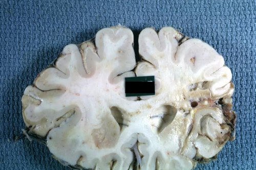 Gross cystic encephalomalacia of the frontal lobe caused by a recent cerebral hemorrhage