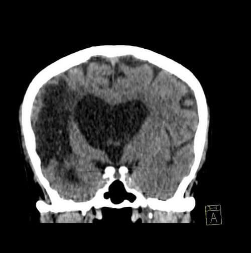 Encephalomalacia after MCA stroke seen on coronal noncontrast CT scan