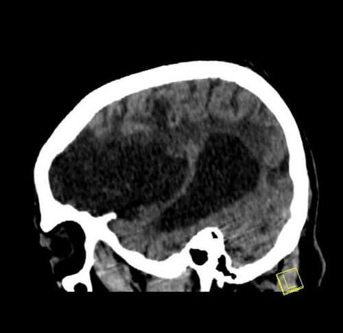 Encephalomalacia after MCA stroke seen on sagittal noncontrast CT scan
