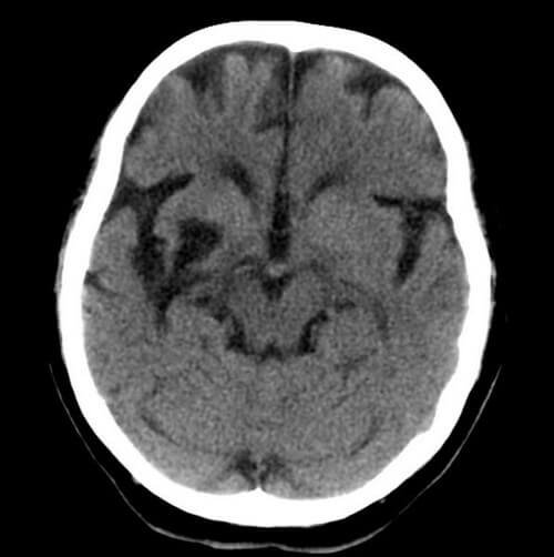 Encephalomalacia after middle cerebral artery (MCA) infarction