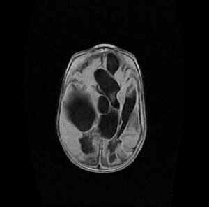 encephalomalacia cystic attenuated mri inversion cerebral