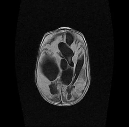 Multiple cystic encephalomalacia on MRI axial fluid attenuated inversion recovery