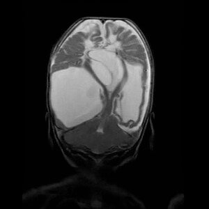 encephalomalacia cystic mri multiple weighted coronal cerebral