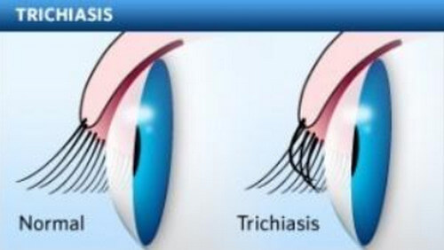 Normal vs Trichiasis or Ingrown Eyelash