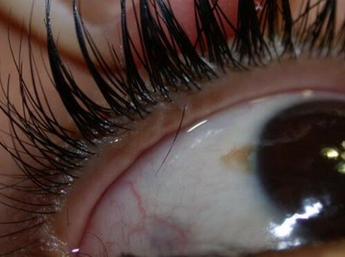 Trichiasis or Ingrown Eyelash 1