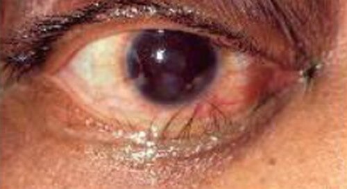 Trichiasis or Ingrown Eyelash 3