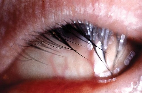 Trichiasis or Ingrown Eyelashes