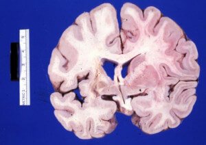 encephalomalacia cystic ganglia basal cerebral