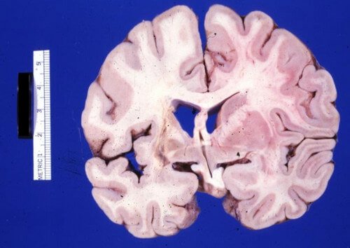 cystic encephalomalacia in left basal ganglia internal capsule