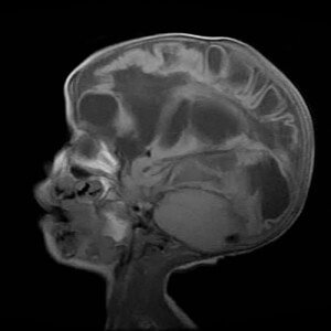 encephalomalacia cystic mri sagittal weighted cerebral