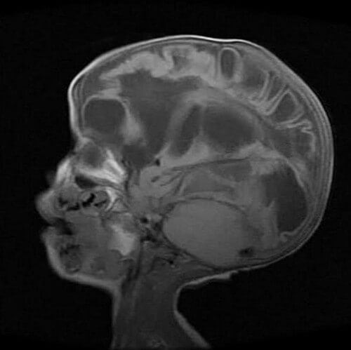 multicystic-encephalomalacia on mri sagittal T1