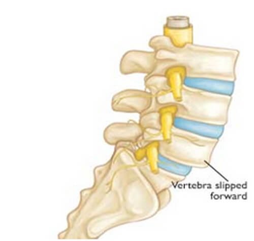 s1 form health Causes, Treatment Diagnosis Anterolisthesis and Grading,