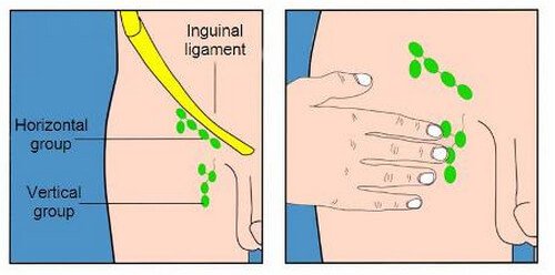 inguinal lymph nodes location picture