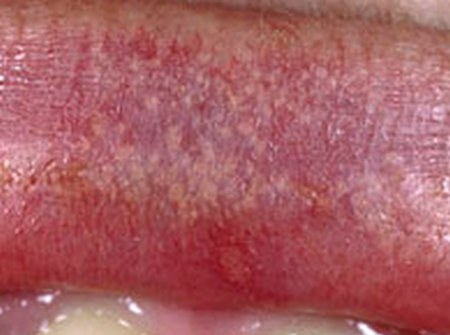 Fordyce spots located on or around the mouth.photo