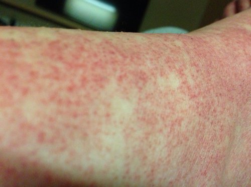 A patient with a petechial rash.image