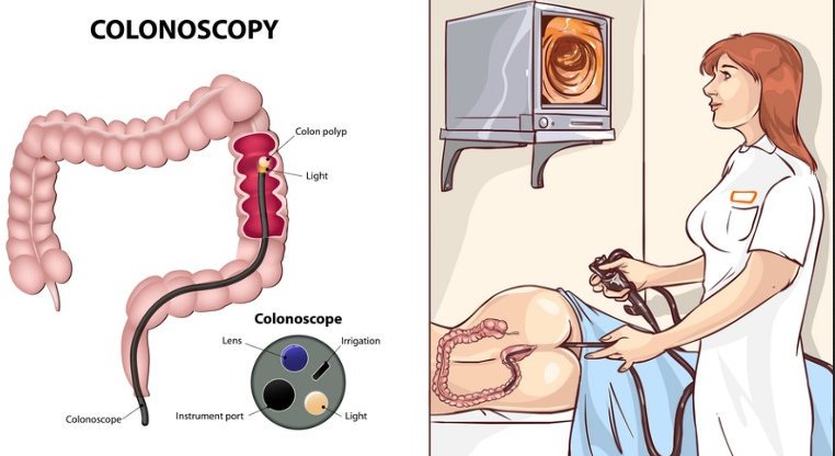 colonoscopy.photo