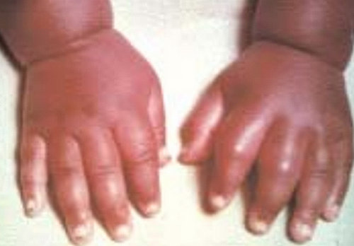 Dactylitis in infant with sickle cell disease.photot