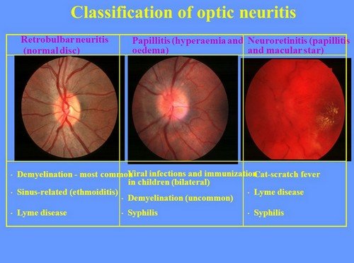 The different classifications of optic neuritis.image