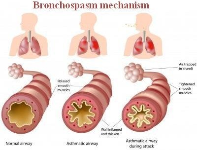 a comparison image of a normal airway and an airway during bronchospasm.picture