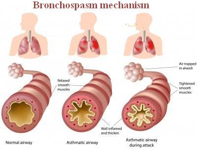 a comparison image of a normal airway and an airway during bronchospasm.picture