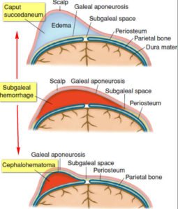 Cephalohematoma - Definition, vs caput succedaneum, treatment