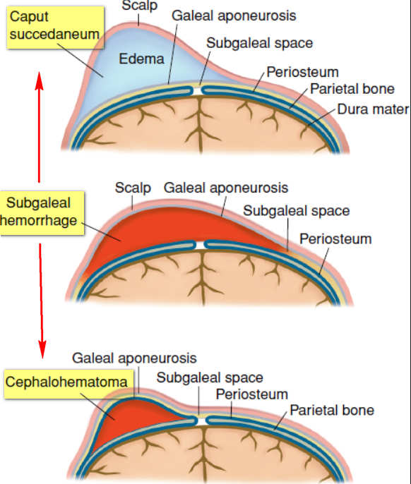 Cephalohematoma Definition Vs Caput Succedaneum Treatment 