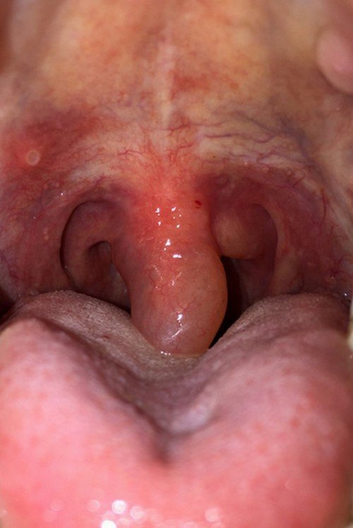 A swollen and irritated uvula.image