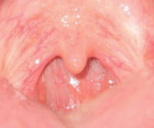 An image of a healthy uvula.photo