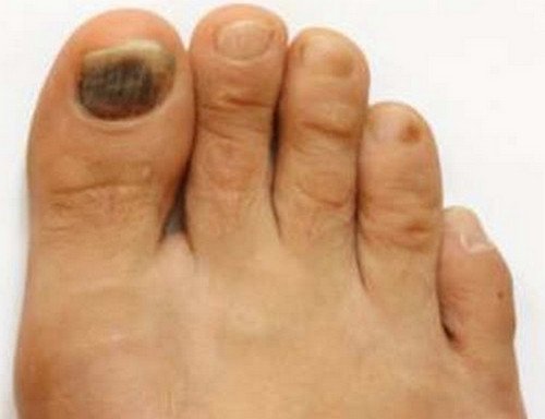 A blackish discoloration of the toenail..photo