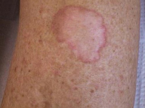 Porokeratosis - Pictures, Types, Causes, Treatment