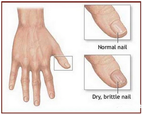 A comparison between a healthy nail and dry, brittle nail.photo